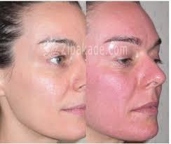 میکرونیدلینگ